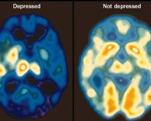 depressed-brain